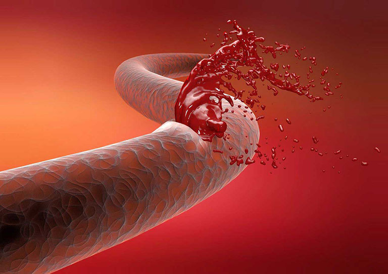 Xuất huyết tiêu hóa xảy ra khi máu khỏi lòng mạch do một số tổn thương tại mạch máu