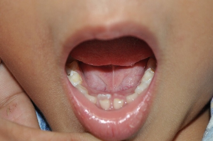 Răng vĩnh viễn mọc lệch vào bên trong cung hàm