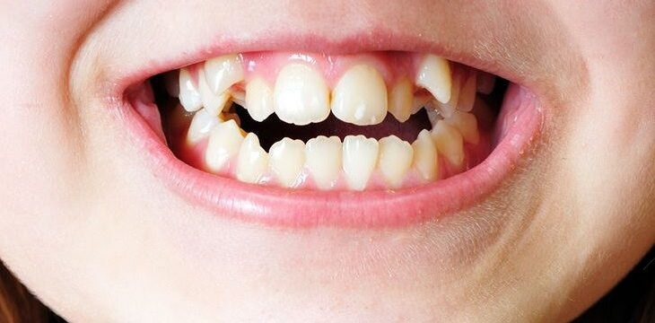 Răng trẻ mọc lẫy gây ra nhiều ảnh hưởng đến thẩm mỹ và khả năng ăn nhai