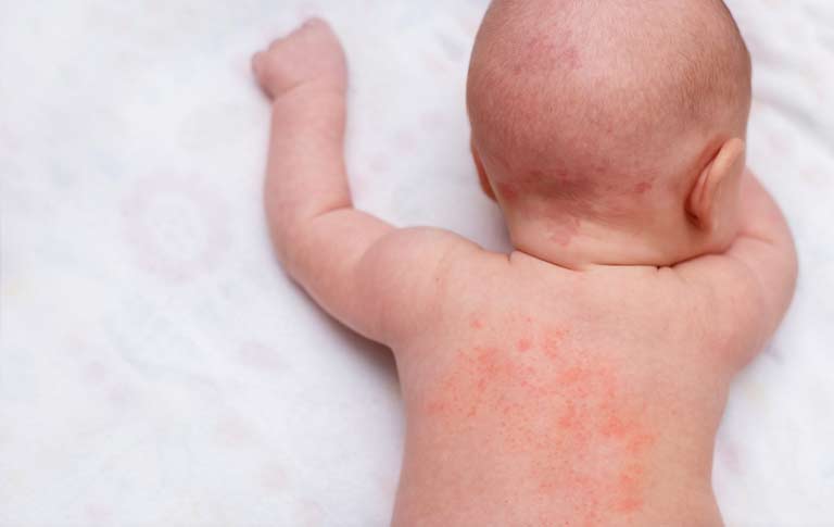 Nhận biết các triệu chứng khi bé bị nổi mẩn đỏ khắp người không sốt không ngứa
