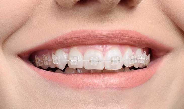 Răng toàn sứ và răng sứ kim loại là hai hình thức bọc răng phổ biến