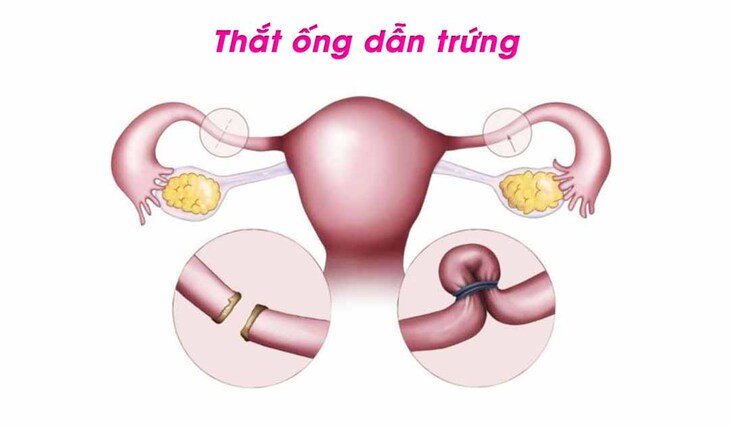 Thắt ống dẫn trứng có tỷ lệ tránh thai cao