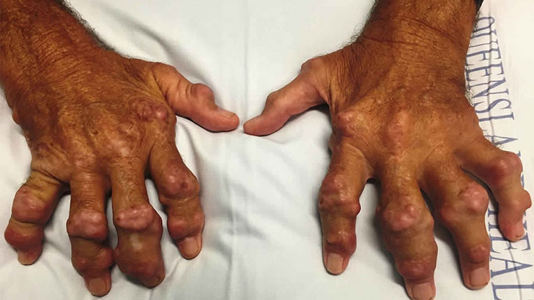 bệnh gout là một trong các loại bệnh về xương khớp thường gặp