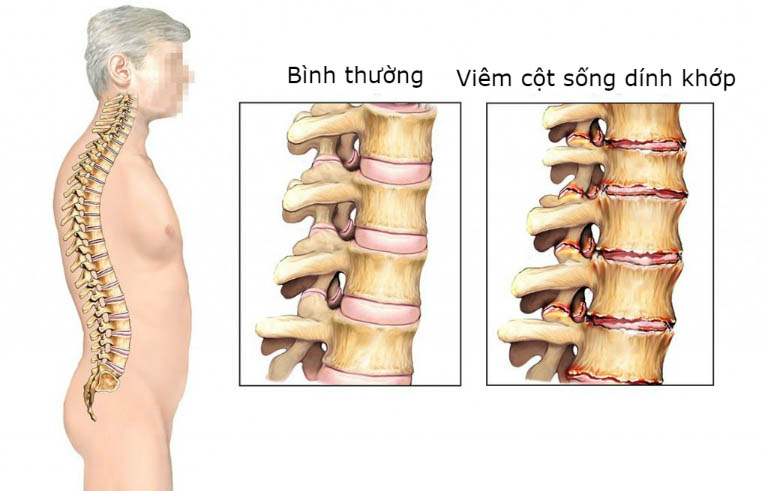 viêm cột sống dính khớp là một trong các loại bệnh về xương khớp thường gặp