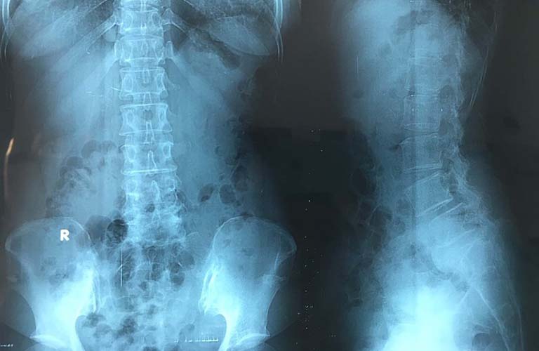 Chụp x-quang giúp phát hiện bệnh thoát vị đĩa đệm nặng đã gây tổn thương nghiêm trọng đến cột sống