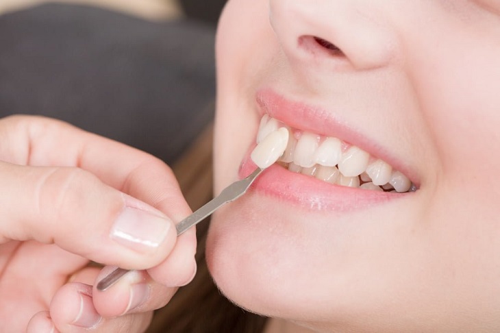 Phương pháp mang lại tính thẩm mỹ cao, bảo tồn tối đa răng thật