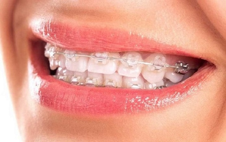 Tình trạng răng miệng hiện tại quyết định đến giá niềng răng mắc cài sứ