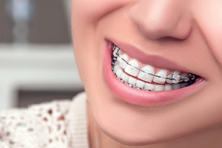 Kỹ thuật niềng răng mắc cài sứ truyền thống được nhiều áp dụng nhiều