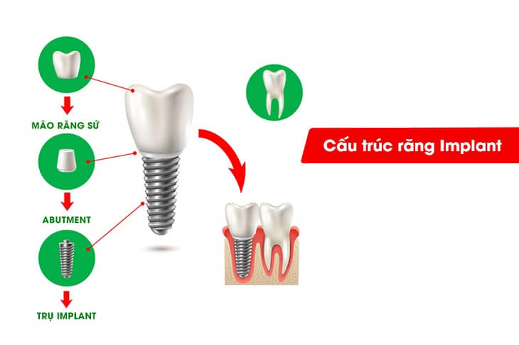 Cấu tạo cơ bản của một răng trồng Implant