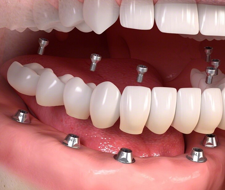 Trường hợp mất răng cả hàm vẫn có thể thực hiện dịch vụ trồng răng Implant
