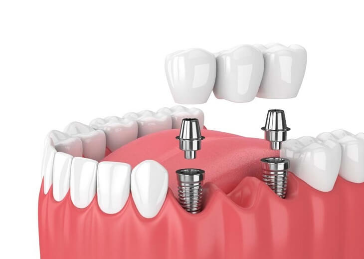 Giá thành của một dịch vụ trồng răng Implant bị chi phối bởi nhiều yếu tố 