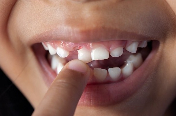 Đến 6 - 7 tuổi trẻ bắt đầu bước vào thời kỳ thay răng sữa