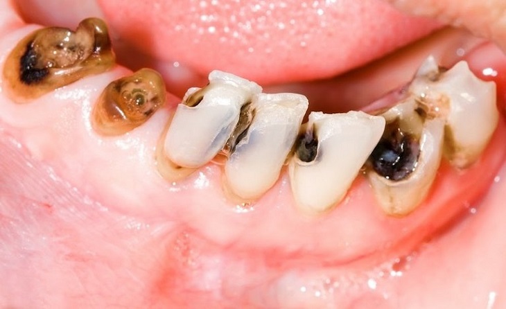Trẻ bị sâu răng nghiêm trọng cần đến nha khoa để nhổ răng càng sớm càng tốt