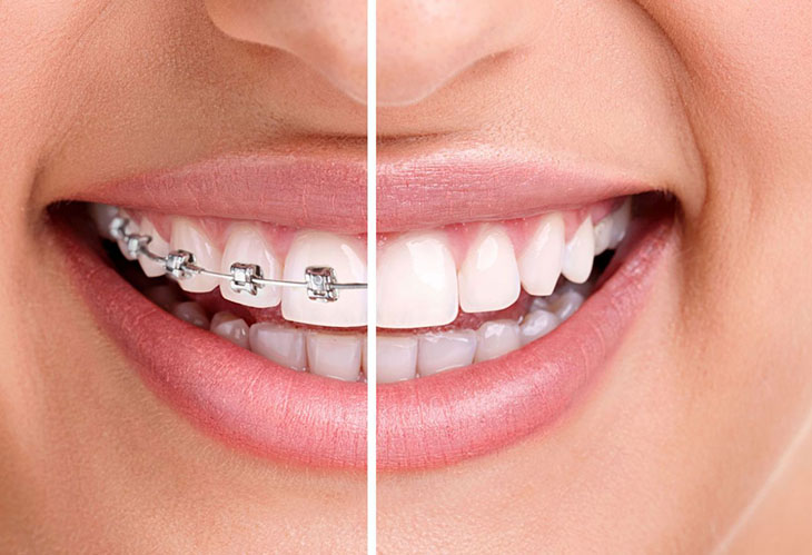 Niềng răng là phương pháp dùng khí cụ điều chỉnh vị trí, khớp cắn răng