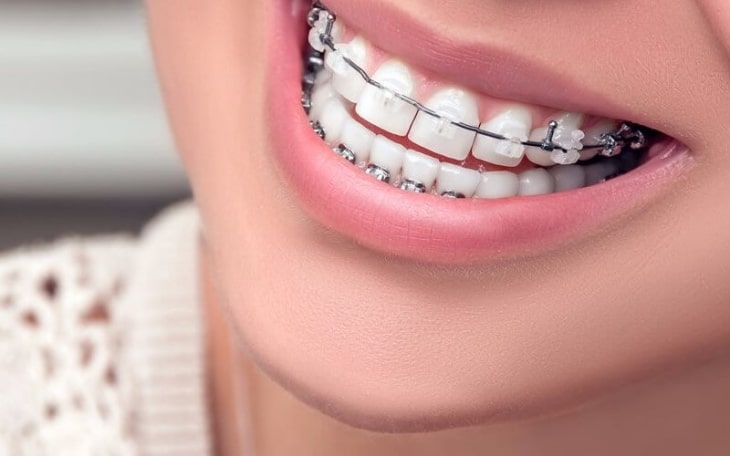Phương pháp niềng răng ngày càng hiện, phù hợp với nhiều lứa tuổi