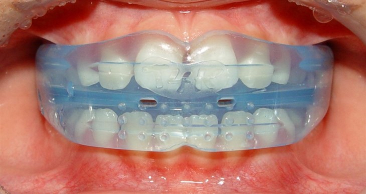 Từ 6 - 11 tuổi trẻ em có thể niềng răng bằng hàm trainer