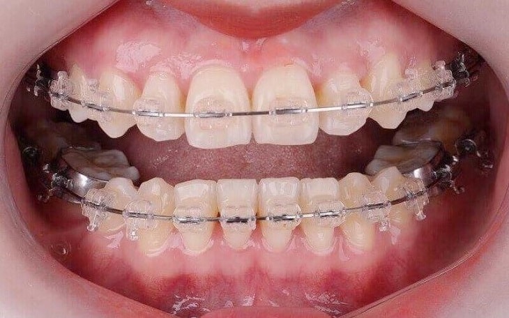 Niềng răng bị tụt lợi sẽ ảnh hưởng đến kết quả niềng răng rất nhiều