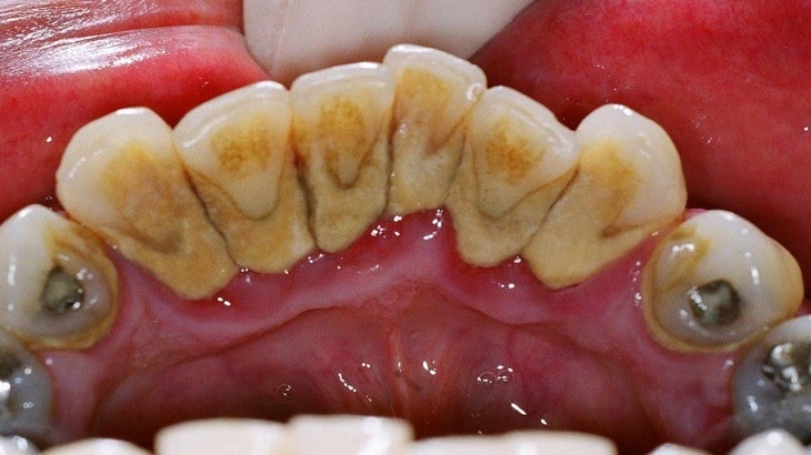 Mảng bám trên cao răng khi niềng cũng là nguyên nhân gây tụt lợi