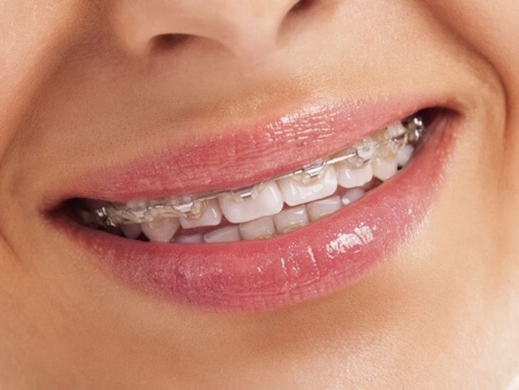 Niềng răng mắc cài là phương pháp chỉnh nha truyền thống và chi phí thấp