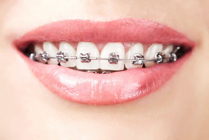 Trong đa số trường hợp, bác sĩ vẫn khuyến cáo bệnh nhân nên niềng răng cả 2 hàm