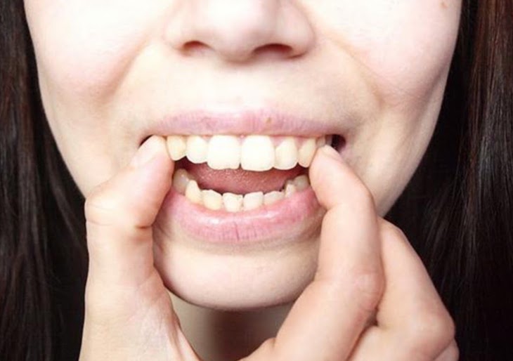 Hô hàm trên mức độ nhẹ có thể thực hiện niềng răng chỉnh nha