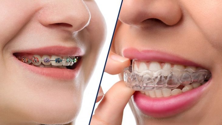 Nên chăm sóc răng miệng theo chế độ đặc biệt khi đeo niềng
