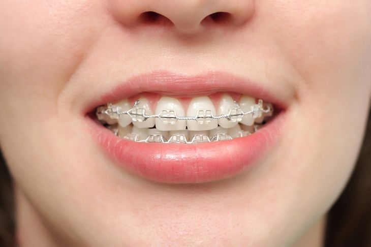 Niềng răng hô là phương pháp chỉnh nha khắc phục tình trạng răng hô vẩu