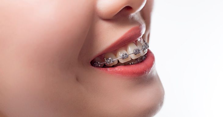 Niềng răng hô giúp phục hồi khả năng ăn nhai và hạn chế mắc các bệnh lý răng miệng