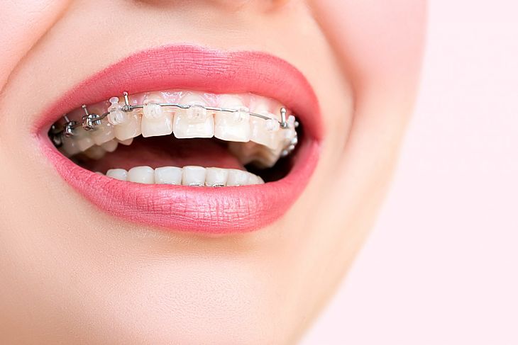 Hiện nay có nhiều phương pháp niềng răng hô bạn có thể lựa chọn