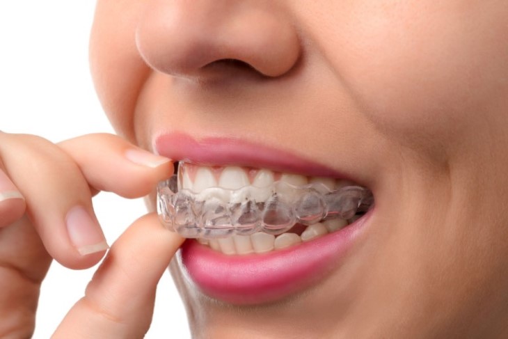 Niềng răng trong suốt Invisalign có nhiều ưu, nhược điểm
