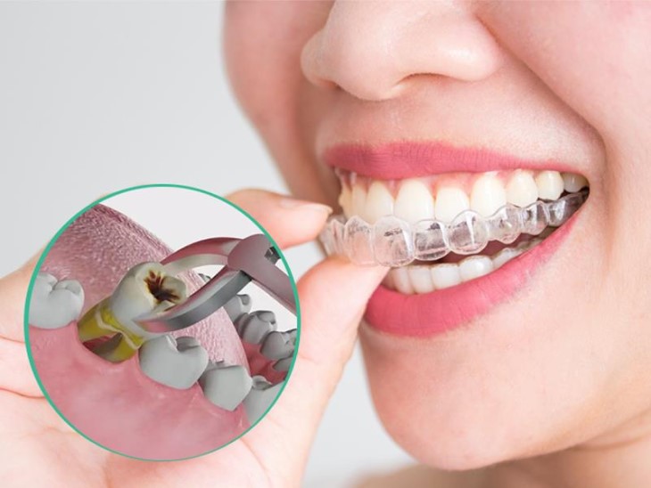 Tùy thuộc vào tình trạng răng miệng mà nha sĩ sẽ chỉ định nhổ răng hay không