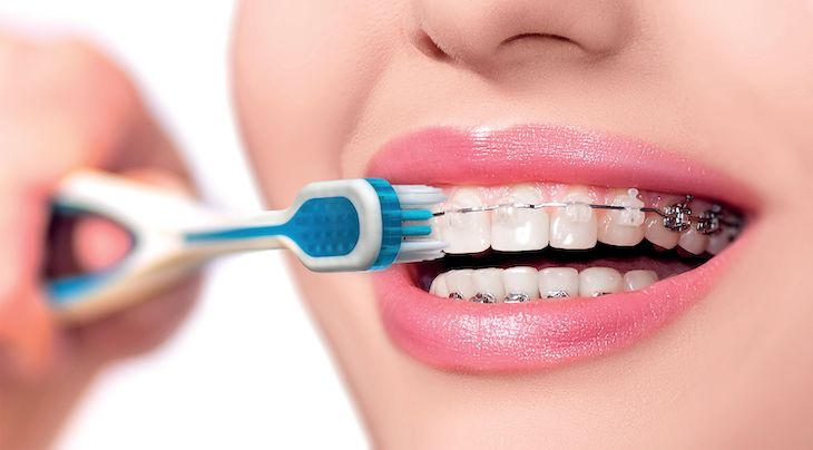 Thói quen vệ sinh răng miệng ảnh hưởng rất nhiều đến quá trình chỉnh nha