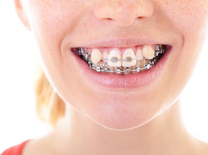 Niềng răng khểnh giúp ổn định chức năng nhai và hạn chế mắc các bệnh răng miệng