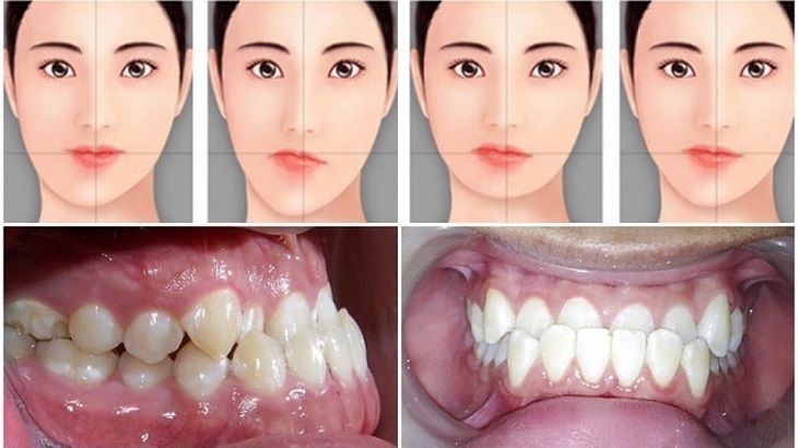 Tình trạng răng miệng bị lệch khớp cắn
