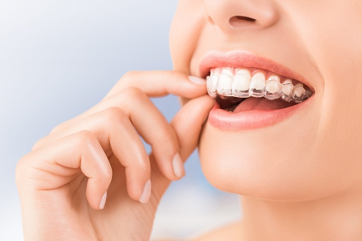 Công nghệ niềng răng Invisalign được nhiều người áp dụng