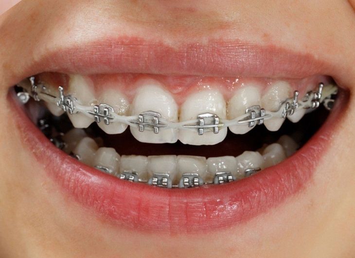 Niềng răng bằng mắc cài kim loại là phương pháp chỉnh nha có mặt từ rất lâu trước đây