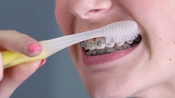 Vệ sinh răng miệng là điều bạn cần lưu ý trong suốt quá trình chỉnh nha