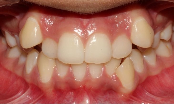 Người có răng mọc khấp khểnh nên chỉnh nha bằng mắc cài kim loại