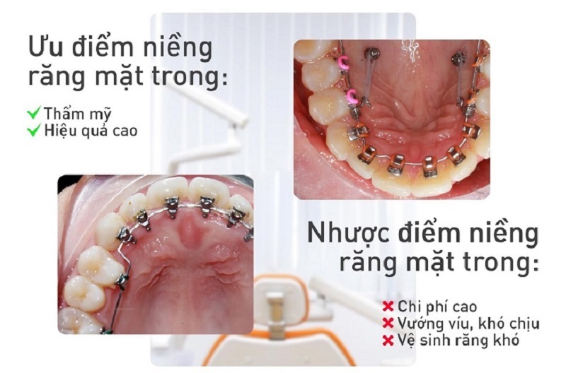 Một số ưu điểm và khuyết điểm nổi bật của quá trình niềng răng mắc cài phía trong