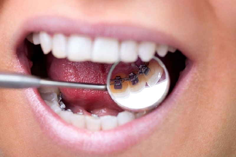 Niềng răng mắc cài mặt trong giá bao nhiêu là thắc mắc chung của rất nhiều người có ý định niềng răng