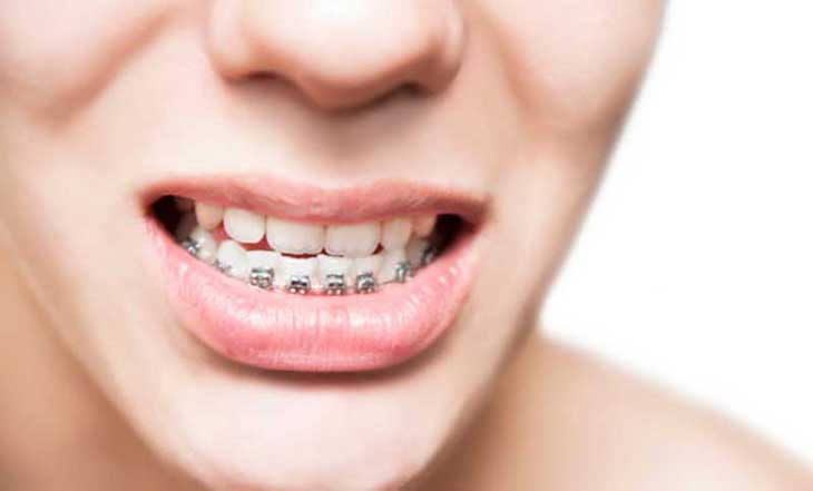 Biện pháp niềng răng móm được chỉ định trong trường hợp móm do răng