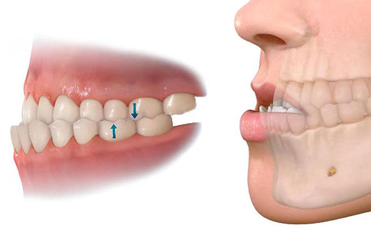 Niềng răng móm hàm trên bao nhiêu tiền phụ thuộc vào từng phương pháp