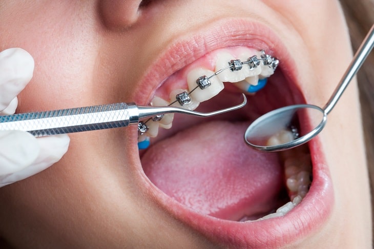 Tùy từng trường hợp sẽ được thực hiện niềng răng nhổ răng số 5