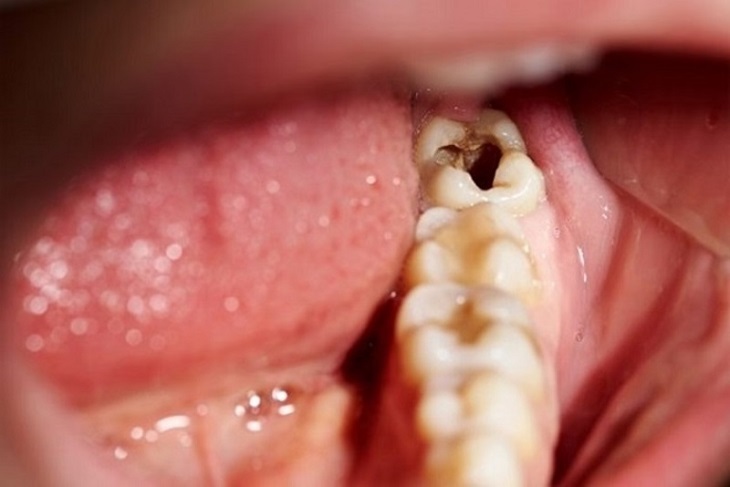 Răng số 6 bị sâu có thể được chỉ định nhổ bỏ trong quá trình niềng