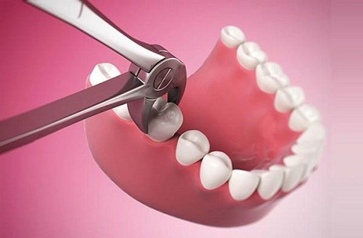 Răng số 6 là răng hàm đóng vai trò rất quan trọng trên cung hàm