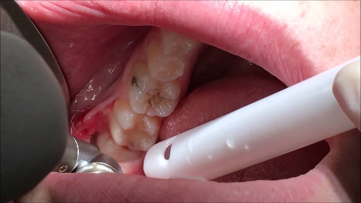 Niềng răng nhổ răng số 8 sẽ bảo vệ được kết quả của quá trình chỉnh nha trước đó