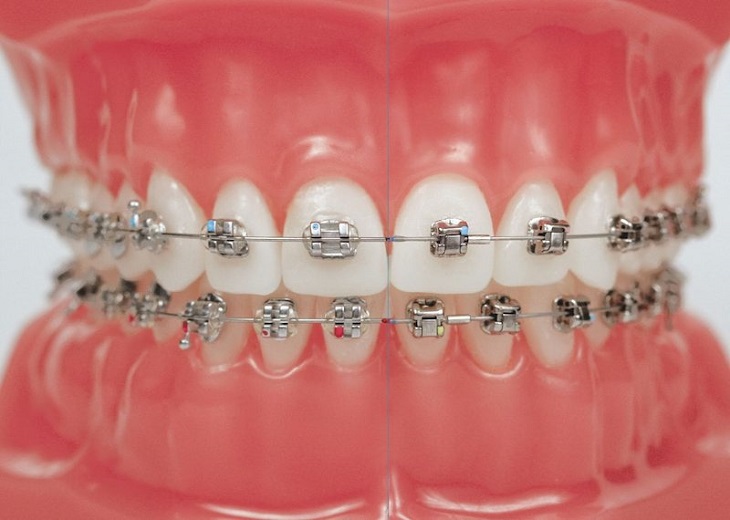 Kỹ thuật niềng răng sắt truyền thống được nhiều người áp dụng