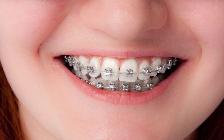 Niềng răng sắt mang lại hiệu quả chỉnh nha tốt