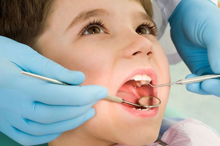 Chi phí niềng răng trainer cho trẻ nhỏ thấp hơn đối với người trưởng thành