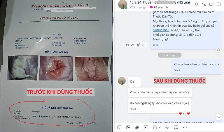 Kết quả khám trước và sau khi dùng Diệp Phụ Khang của chị Huyền